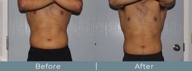 Before and After Photos of a Laser Body Contouring Procedure