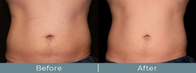 truSculptiD Before and After Photo