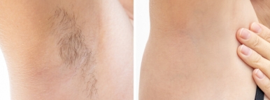 Photo of armpits before and after laser hair removal