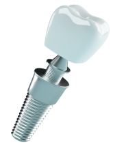 dental implant