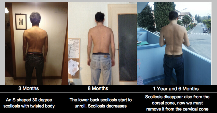 evolution starecta scoliosis