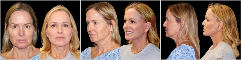 Before and After Facelift by Dr. Roy David