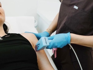 stretch marks removal on shoulder using rf microneedling at lakewood, colorado skin clinic