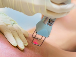 stretch marks removal on breast using a co2 laser at lakewood colorado skin clinic