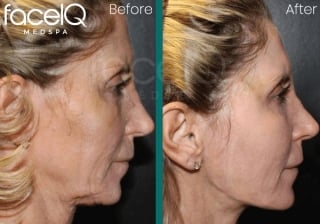 patient before and after facial skin tightening