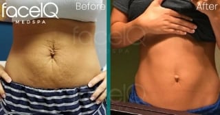 woman's stomach before and after skin tightening
