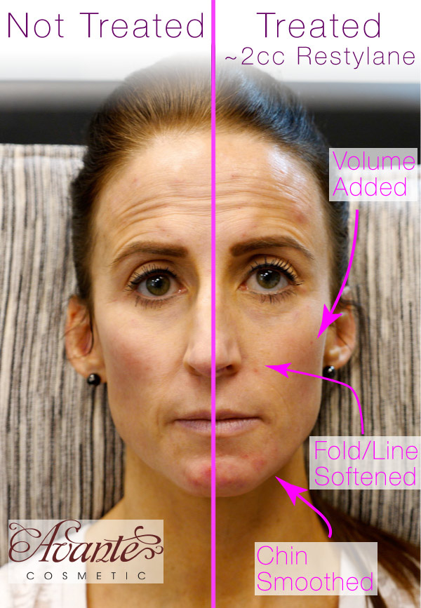 before and after pic of patient treated with Restylane dermal filler in nasolabial folds and cheeks