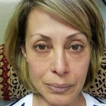 woman after under eye filler treatment for eye bags