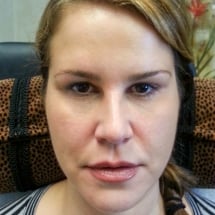 woman after under eye filler