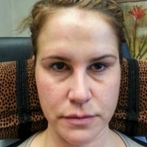 woman before under eye filler treatment in her tear troughs for hollow eyes