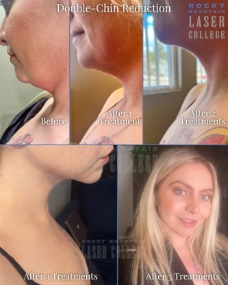 before and after pictures of a kybella treatment to remove fat from a double chin