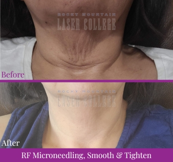 woman with crepey neck skin before and after rf microneedling neck skin tightening treatment