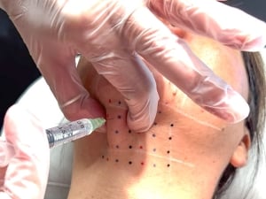 patient being injected with kybella to get rid of their double chin and tightening their neck