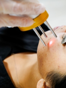 patient with melasma is treated with a pico laser