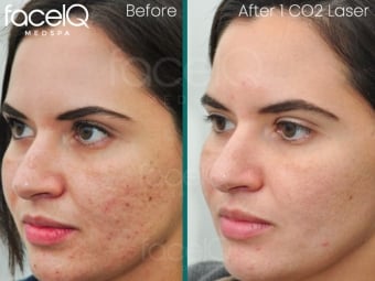 before and after picture showing the skin improvement of a patient after a co2 laser treatment