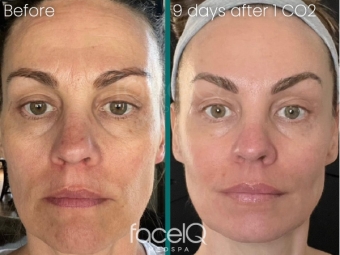 split image with a woman's face before a CO2 laser facial with uneven skin tone, lines and wrinkles next to her image after a co2 laser facial with noticeably improved skin