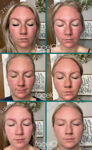 series of 6 photos showing the healing and recovery progression after a CO2 laser facial treatment