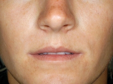 before lip filler augmentation