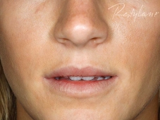 after lip filler augmentation