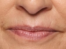 before lip filler augmentation
