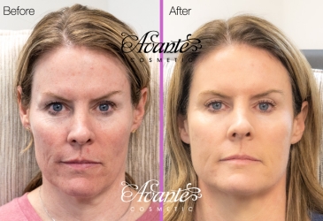 female patient facing forwards before and after pictures for a sculptra anti-aging treatment
