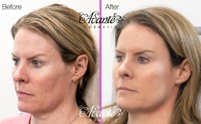 female patient facing right, before and after pictures for a sculptra anti-aging treatment