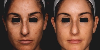 before and after sun spot removal treatment using pico laser