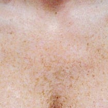 Before IPL treatment for sunspots and freckles in Denver