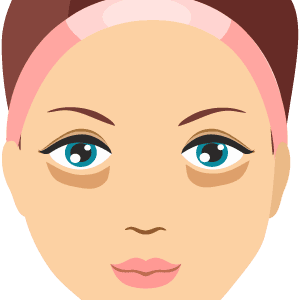 under eye filler for tear trough eye bags and hollows