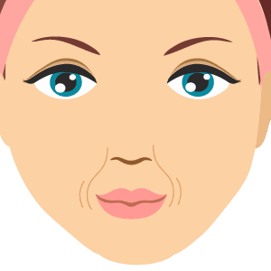 cheek filler for nasolabial folds and smile lines