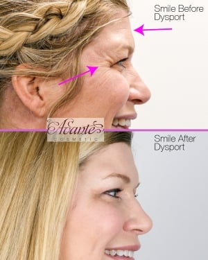 forehead lines, crow's feet, and frown lines before & after dysport tox treatment