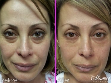 under eye bags before and after a tear trough filler treatment