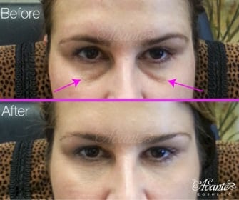 hollow eyes before and after under eye filler treatment