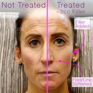 before and after a cheek filler treatment to soften nasolabial folds and smile lines