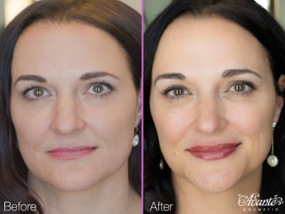 before and after a lip filler treatment with 2cc of kysse filler