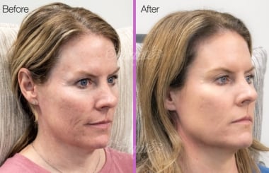 side view of before and after a sculptra treatment for facial volume loss