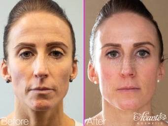 before and after an anti-aging facial balancing treatment with tox and dermal filler