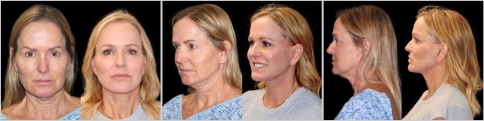 Before and After Facelift by Dr. Roy David