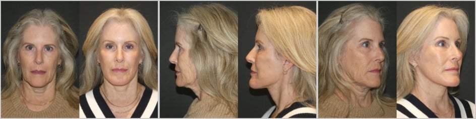 Before and After Facelift by Dr. Roy David