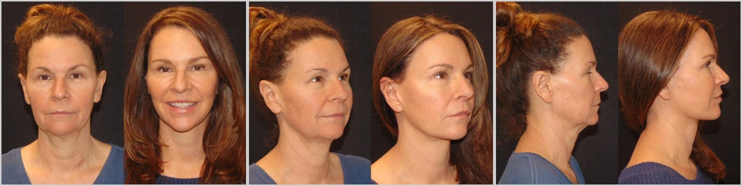 Before and After Facelift by Dr. Roy David
