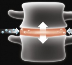 Back Pain Relief - Spinal Decompression
