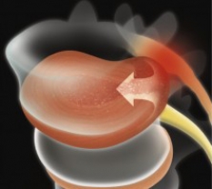 Back Pain Relief - Spinal Decompression