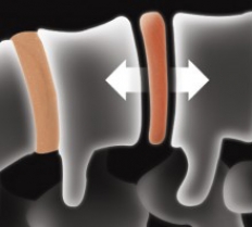 Back Pain Relief - Spinal Decompression