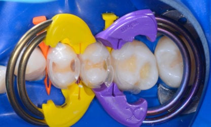 Bioclear Method: Twin Rings and clear matrices in place. POsterior restoration