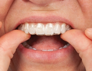 Opalescence PF with aligners: clinical technique. Step 2
