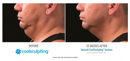 CoolSculpting Double Chin Male 12 Weeks After 2nd Session