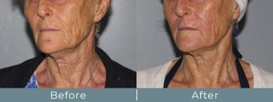 RF Microneedling Before and After Photo