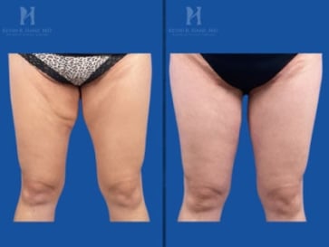 Before and after image