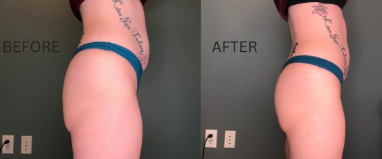 Before and after images of Emsculpt