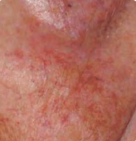 Lesions Around the Eye